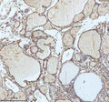 IHC analysis of IRF2BPL using anti-IRF2BPL antibody. IRF2BPL was detected in a paraffin-embedded section of follicles of human thyroid cancer tissue. Heat mediated antigen retrieval was performed in EDTA buffer (pH 8.0, epitope retrieval solution). The tissue section was blocked with 10% goat serum. The tissue section was then incubated with 2 ug/ml rabbit anti-IRF2BPL antibody overnight at 4oC. Peroxidase Conjugated Goat Anti-rabbit IgG was used as secondary antibody and incubated for 30 min at 37oC.