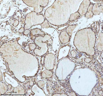 IHC analysis of IRF2BPL using anti-IRF2BPL antibody. IRF2BPL was detected in a paraffin-embedded section of follicles of human thyroid cancer tissue. Heat mediated antigen retrieval was performed in EDTA buffer (pH 8.0, epitope retrieval solution). The tissue section was blocked with 10% goat serum. The tissue section was then incubated with 2 ug/ml rabbit anti-IRF2BPL antibody overnight at 4oC. Peroxidase Conjugated Goat Anti-rabbit IgG was used as secondary antibody and incubated for 30 min at 37oC.