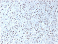 IHC testing of FFPE human mesothelioma tissue with recombinant WT1 antibody (clone WT1/1434R). HIER: steam sections in pH 9 10mM Tris with 1mM EDTA for 10-20 min.