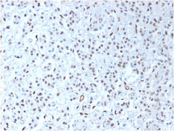 IHC testing of FFPE human mesothelioma tissue with recombinant WT1 antibody (clone WT1/1434R). HIER: steam sections in pH 9 10mM Tris with 1mM EDTA for 10-20 min.