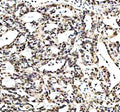 Immunohistochemical staining of RTRAF using anti-RTRAF antibody. RTRAF was detected in a paraffin-embedded section of human prostate cancer tissue. Heat mediated antigen retrieval was performed in EDTA buffer (pH 8.0, epitope retrieval solution). The tissue section was blocked with 10% goat serum. The tissue section was then incubated with 2 ug/ml rabbit anti-RTRAF antibody overnight at 4oC. Peroxidase Conjugated Goat Anti-rabbit IgG was used as secondary antibody and incubated for 30 min at 37oC.