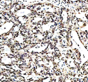 Immunohistochemical staining of RTRAF using anti-RTRAF antibody. RTRAF was detected in a paraffin-embedded section of human prostate cancer tissue. Heat mediated antigen retrieval was performed in EDTA buffer (pH 8.0, epitope retrieval solution). The tissue section was blocked with 10% goat serum. The tissue section was then incubated with 2 ug/ml rabbit anti-RTRAF antibody overnight at 4oC. Peroxidase Conjugated Goat Anti-rabbit IgG was used as secondary antibody and incubated for 30 min at 37oC.