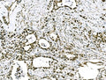IHC staining of FFPE human stomach cancer tissue with GRHL2 antibody. HIER: boil tissue sections in pH8 EDTA for 20 min and allow to cool before testing.