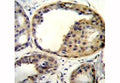AKT1 antibody immunohistochemistry analysis in formalin fixed and paraffin embedded human breast carcinoma