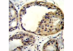 AKT1 antibody immunohistochemistry analysis in formalin fixed and paraffin embedded human breast carcinoma