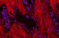 Immunofluorescent staining of human lung cancer tissue with p62 antibody (red) at 1ug/ml and DAPI counterstain. HIER: boil tissue sections in pH6, 10mM citrate buffer, for 10-20 min and allow to cool before testing.