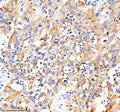 Immunohistochemical staining of CARD10 using anti-CARD10 antibody. CARD10 was detected in a paraffin-embedded section of human bladder cancer tissue. Heat mediated antigen retrieval was performed in EDTA buffer (pH 8.0, epitope retrieval solution). The tissue section was blocked with 10% goat serum. The tissue section was then incubated with 2 ug/ml rabbit anti-CARD10 antibody overnight at 4oC. Peroxidase Conjugated Goat Anti-rabbit IgG was used as secondary antibody and incubated for 30 min at 37oC.