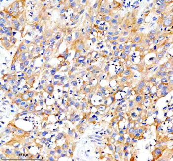 Immunohistochemical staining of CARD10 using anti-CARD10 antibody. CARD10 was detected in a paraffin-embedded section of human bladder cancer tissue. Heat mediated antigen retrieval was performed in EDTA buffer (pH 8.0, epitope retrieval solution). The tissue section was blocked with 10% goat serum. The tissue section was then incubated with 2 ug/ml rabbit anti-CARD10 antibody overnight at 4oC. Peroxidase Conjugated Goat Anti-rabbit IgG was used as secondary antibody and incubated for 30 min at 37oC.