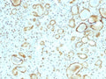 IHC staining of FFPE human renal cell carcinoma with STAT3 antibody (clone STAT6/2410). HIER: boil tissue sections in pH6, 10mM citrate buffer, for 10-20 min followed by cooling at RT for 20 min.