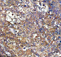 Immunohistochemical staining of PEX11B using anti-PEX11B antibody. PEX11B was detected in a paraffin-embedded section of human liver cancer tissue. Heat mediated antigen retrieval was performed in EDTA buffer (pH 8.0, epitope retrieval solution). The tissue section was blocked with 10% goat serum. The tissue section was then incubated with 1:50 rabbit anti-PEX11B antibody overnight at 4oC. Peroxidase Conjugated Goat Anti-rabbit IgG was used as secondary antibody and incubated for 30 min at 37oC.