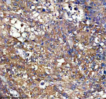 Immunohistochemical staining of PEX11B using anti-PEX11B antibody. PEX11B was detected in a paraffin-embedded section of human liver cancer tissue. Heat mediated antigen retrieval was performed in EDTA buffer (pH 8.0, epitope retrieval solution). The tissue section was blocked with 10% goat serum. The tissue section was then incubated with 1:50 rabbit anti-PEX11B antibody overnight at 4oC. Peroxidase Conjugated Goat Anti-rabbit IgG was used as secondary antibody and incubated for 30 min at 37oC.