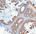 Immunohistochemical staining of SYNJ2 using anti-SYNJ2 antibody. SYNJ2 was detected in a paraffin-embedded section of human ovarian cancer tissue. Heat mediated antigen retrieval was performed in EDTA buffer (pH 8.0, epitope retrieval solution). The tissue section was blocked with 10% goat serum. The tissue section was then incubated with 2 ug/ml rabbit anti-SYNJ2 antibody overnight at 4oC. Peroxidase Conjugated Goat Anti-rabbit IgG was used as secondary antibody and incubated for 30 min at 37oC.