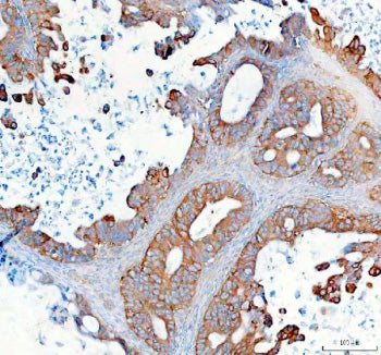 Immunohistochemical staining of SYNJ2 using anti-SYNJ2 antibody. SYNJ2 was detected in a paraffin-embedded section of human ovarian cancer tissue. Heat mediated antigen retrieval was performed in EDTA buffer (pH 8.0, epitope retrieval solution). The tissue section was blocked with 10% goat serum. The tissue section was then incubated with 2 ug/ml rabbit anti-SYNJ2 antibody overnight at 4oC. Peroxidase Conjugated Goat Anti-rabbit IgG was used as secondary antibody and incubated for 30 min at 37oC.
