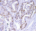 IHC staining of FFPE human colon cancer tissue with Survivin antibody. HIER: boil tissue sections in pH8 EDTA for 20 min and allow to cool before testing.