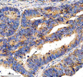 Immunohistochemical staining of EIF3H using anti-EIF3H antibody. EIF3H was detected in a paraffin-embedded section of human colon cancer tissue. Heat mediated antigen retrieval was performed in EDTA buffer (pH 8.0, epitope retrieval solution). The tissue section was blocked with 10% goat serum. The tissue section was then incubated with 2 ug/ml rabbit anti-EIF3H antibody overnight at 4oC. Peroxidase Conjugated Goat Anti-rabbit IgG was used as secondary antibody and incubated for 30 min at 37oC.