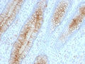 IHC: Formalin-fixed, paraffin-embedded human colon carcinoma stained with Beta-2-Microglobulin antibody (clone B2M/961).