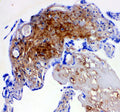 IHC-P: Decorin antibody testing of human breast cancer tissue. HIER: boil tissue sections in pH6, 10mM citrate buffer, for 20 min and allow to cool before testing.