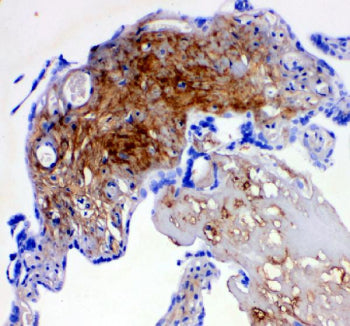 IHC-P: Decorin antibody testing of human breast cancer tissue. HIER: boil tissue sections in pH6, 10mM citrate buffer, for 20 min and allow to cool before testing.