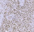 IHC staining of FFPE human testicular cancer tissue with Synaptonemal Complex Protein 3 antibody. HIER: boil tissue sections in pH8 EDTA for 20 min and allow to cool before testing.