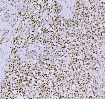 IHC staining of FFPE human testicular cancer tissue with Synaptonemal Complex Protein 3 antibody. HIER: boil tissue sections in pH8 EDTA for 20 min and allow to cool before testing.