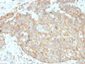 IHC staining of FFPE human breast carcinoma with DR5 antibody. HIER: boil tissue sections in pH 9 10mM Tris with 1mM EDTA for 20 min and allow to cool before testing.