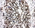 IHC-P: Ku80 antibody testing of human breast cancer tissue. HIER: boil tissue sections in pH6, 10mM citrate buffer, for 20 min and allow to cool before testing.