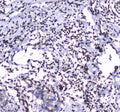 IHC testing of FFPE human breast cancer tissue with GFI1 antibody at 1ug/ml. Required HIER: steam section in pH6 citrate buffer for 20 min and allow to cool prior to staining.