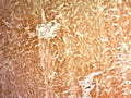 IHC: Formalin-fixed, paraffin-embedded human hepatocellular carcinoma stained with Glypican-3 antibody (clone 1G12).