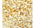 IHC analysis of FFPE human prostate carcinoma stained with NKX3.1 antibody
