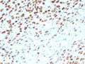 IHC staining of FFPE human bladder tissue with TP53 antibody (clone rTP53/3889). HIER: boil tissue sections in pH 9 10mM Tris with 1mM EDTA for 20 min and allow to cool before testing.