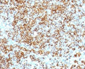 IHC: Formalin-fixed, paraffin-embedded human lymphoma stained with anti-CD45RB antibody (SPM569).