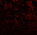 Immunofluorescent staining of FFPE human breast cancer tissue with DIS3 antibody (red). HIER: steam section in pH8 EDTA buffer for 20 min.