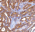 IHC staining of FFPE human rectum adenocarcinoma tissue with OTUB1 antibody. HIER: boil tissue sections in pH8 EDTA for 20 min and allow to cool before testing.