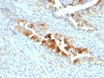 IHC staining of FFPE human endometrial carcinoma with Mesothelin antibody (clone SPM143). HIER: boil tissue sections in pH 9 10mM Tris with 1mM EDTA for 10-20 min followed by cooling at RT for 20 min.