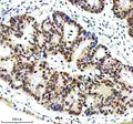 Immunohistochemical staining of ERCC5 using anti-ERCC5 antibody. ERCC5 was detected in a paraffin-embedded section of human colon cancer tissue. Heat mediated antigen retrieval was performed in EDTA buffer (pH 8.0, epitope retrieval solution). The tissue section was blocked with 10% goat serum. The tissue section was then incubated with 2 ug/ml rabbit anti-ERCC5 antibody overnight at 4oC. Peroxidase Conjugated Goat Anti-rabbit IgG was used as secondary antibody and incubated for 30 min at 37oC.
