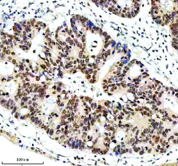 Immunohistochemical staining of ERCC5 using anti-ERCC5 antibody. ERCC5 was detected in a paraffin-embedded section of human colon cancer tissue. Heat mediated antigen retrieval was performed in EDTA buffer (pH 8.0, epitope retrieval solution). The tissue section was blocked with 10% goat serum. The tissue section was then incubated with 2 ug/ml rabbit anti-ERCC5 antibody overnight at 4oC. Peroxidase Conjugated Goat Anti-rabbit IgG was used as secondary antibody and incubated for 30 min at 37oC.