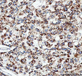 IHC staining of FFPE human liver cancer tissue with TFAM antibody. HIER: boil tissue sections in pH8 EDTA for 20 min and allow to cool before testing.