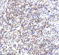 IHC analysis of SCNM1 using anti-SCNM1 antibody. SCNM1 was detected in a paraffin-embedded section of human stomach cancer tissue. Heat mediated antigen retrieval was performed in EDTA buffer (pH 8.0, epitope retrieval solution). The tissue section was blocked with 10% goat serum. The tissue section was then incubated with 2 ug/ml rabbit anti-SCNM1 antibody overnight at 4oC. Peroxidase Conjugated Goat Anti-rabbit IgG was used as secondary antibody and incubated for 30 min at 37oC.