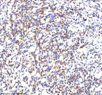 IHC analysis of SCNM1 using anti-SCNM1 antibody. SCNM1 was detected in a paraffin-embedded section of human stomach cancer tissue. Heat mediated antigen retrieval was performed in EDTA buffer (pH 8.0, epitope retrieval solution). The tissue section was blocked with 10% goat serum. The tissue section was then incubated with 2 ug/ml rabbit anti-SCNM1 antibody overnight at 4oC. Peroxidase Conjugated Goat Anti-rabbit IgG was used as secondary antibody and incubated for 30 min at 37oC.