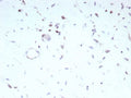 IHC staining of FFPE human rhabdomyosarcoma tissue with recombinant Myoblast determination protein 1 antibody (clone MYOD1/9405R). HIER: boil tissue sections in pH 9 10mM Tris with 1mM EDTA for 20 min and allow to cool before testing.