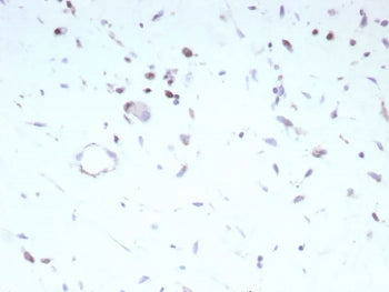 IHC staining of FFPE human rhabdomyosarcoma tissue with recombinant Myoblast determination protein 1 antibody (clone MYOD1/9405R). HIER: boil tissue sections in pH 9 10mM Tris with 1mM EDTA for 20 min and allow to cool before testing.