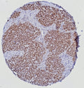 IHC staining of FFPE human prostate tissue with ETS-related gene antibody (clone ERG/6980) at 2ug/ml. HIER: boil tissue sections in pH 9 10mM Tris with 1mM EDTA for 20 min and allow to cool before testing.