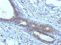 BRCA1 Antibody Breast Carcinoma IHC. Immunohistochemistry analysis of FFPE human breast carcinoma tissue using BRCA1 antibody clone BRCA1/1398. Tumor epithelial cells demonstrate predominantly nuclear HRP-DAB brown staining consistent with the chromatin-associated localization of BRCA1 in hereditary breast cancer-associated DNA repair, homologous recombination signaling, and genomic stability maintenance pathways, while surrounding stromal regions show comparatively lower signal intensity.