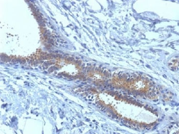 BRCA1 Antibody Breast Carcinoma IHC. Immunohistochemistry analysis of FFPE human breast carcinoma tissue using BRCA1 antibody clone BRCA1/1398. Tumor epithelial cells demonstrate predominantly nuclear HRP-DAB brown staining consistent with the chromatin-associated localization of BRCA1 in hereditary breast cancer-associated DNA repair, homologous recombination signaling, and genomic stability maintenance pathways, while surrounding stromal regions show comparatively lower signal intensity.