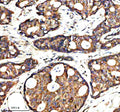 Immunohistochemical staining of SYAP1 using anti-SYAP1 antibody. SYAP1 was detected in a paraffin-embedded section of human breast cancer tissue. Heat mediated antigen retrieval was performed in EDTA buffer (pH 8.0, epitope retrieval solution). The tissue section was blocked with 10% goat serum. The tissue section was then incubated with 2 ug/ml rabbit anti-SYAP1 antibody overnight at 4oC. Peroxidase Conjugated Goat Anti-rabbit IgG was used as secondary antibody and incubated for 30 min at 37oC.