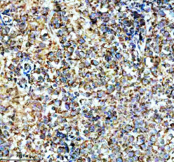 Immunohistochemical staining of SPATA6 using anti-SPATA6 antibody. SPATA6 was detected in a paraffin-embedded section of human testis cancer tissue. Heat mediated antigen retrieval was performed in EDTA buffer (pH 8.0, epitope retrieval solution). The tissue section was blocked with 10% goat serum. The tissue section was then incubated with 2 ug/ml rabbit anti-SPATA6 antibody overnight at 4oC. Peroxidase Conjugated Goat Anti-rabbit IgG was used as secondary antibody and incubated for 30 min at 37oC.
