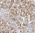 IHC staining of FFPE human lung adenocarcinoma tissue with MACROH2A1 antibody. HIER: boil tissue sections in pH8 EDTA for 20 min and allow to cool before testing.