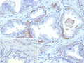 IHC staining of FFPE human prostate carcinoma tissue with recombinant KRT13 antibody (clone rKRT13/9623). Inset: PBS used in place of primary Ab (secondary Ab negative control). HIER: boil tissue sections in pH 9 10mM Tris with 1mM EDTA for 20 min and allow to cool before testing.