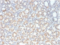IHC staining of FFPE human gastric carcinoma tissue with recombinant Mucin-3 antibody (clone rMUC3/1154). HIER: boil tissue sections in pH 9 10mM Tris with 1mM EDTA for 20 min and allow to cool before testing.