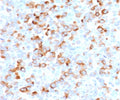 IHC staining of FFPE human melanoma with recombinant Tyrosinase antibody (clone TRSN1-2R). Required HIER: boil tissue sections in 10mM Tris with 1mM EDTA, pH9, or 10mM citrate buffer, pH6, for 10-20 min followed by cooling at RT for 20 min.